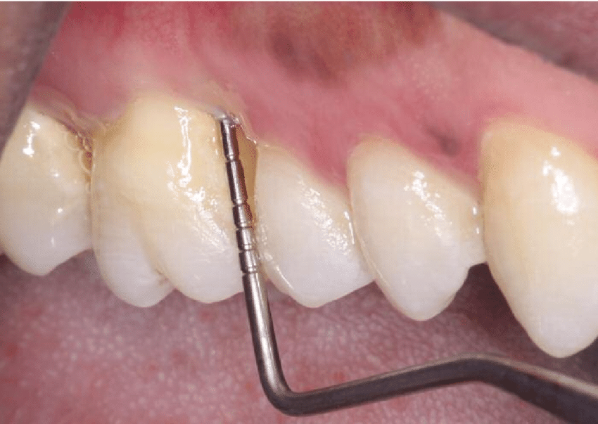 Waldent William's Probe (15/734)