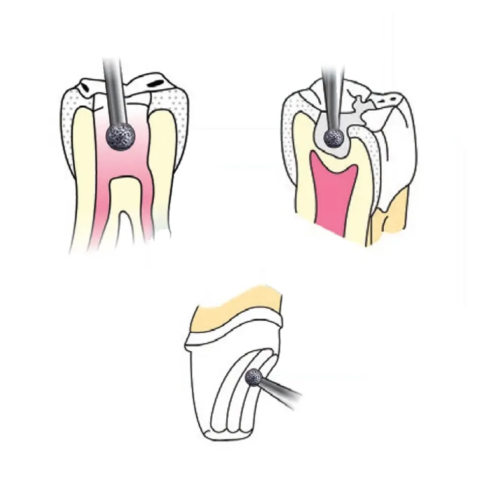 Prima Dental Round Diamond Airotor Burs (Pack Of 5 Burs) - 801(08)