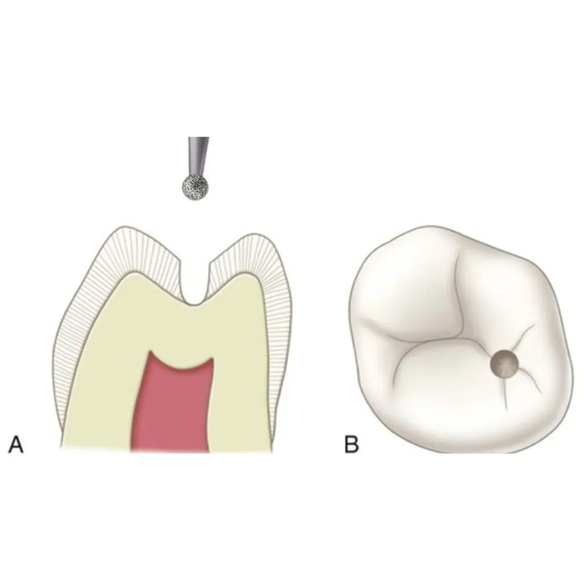 Mani Diamond Bur - Br-46 CA (For Contra-angle)