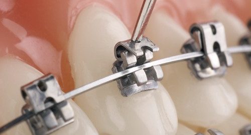 UU Ortho premium Self Ligating Brackets Mbt 0.022