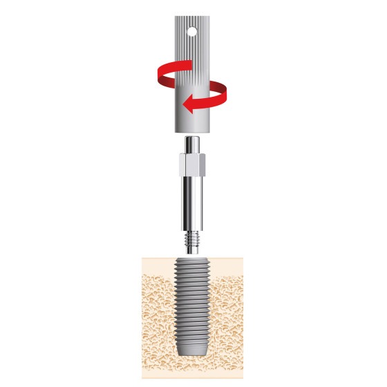 DentalPlant SmartPeg Mount