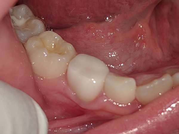 Kids-e-Dental BioFlx Lower Right 2nd Molar Crowns Refills
