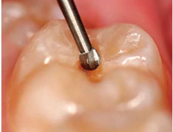 SS White Round Carbide Contra Angle Bur RA - 6 (310006) Pack Of 5