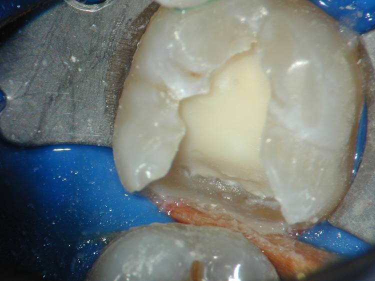 Medicept Dental Hydrocal LC (Calcium Hydroxide + Barium Sulphate LC)