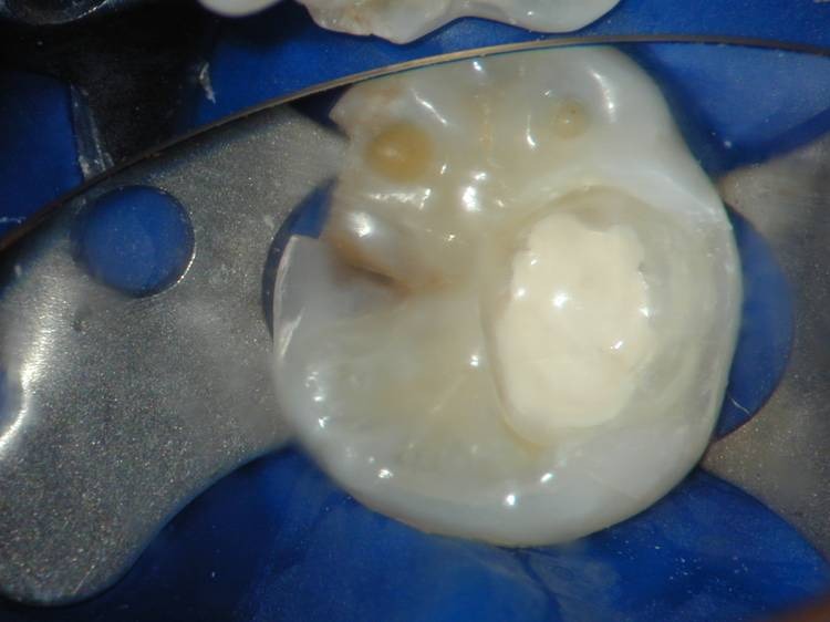 Medicept Dental Hydrocal LC (Calcium Hydroxide + Barium Sulphate LC)