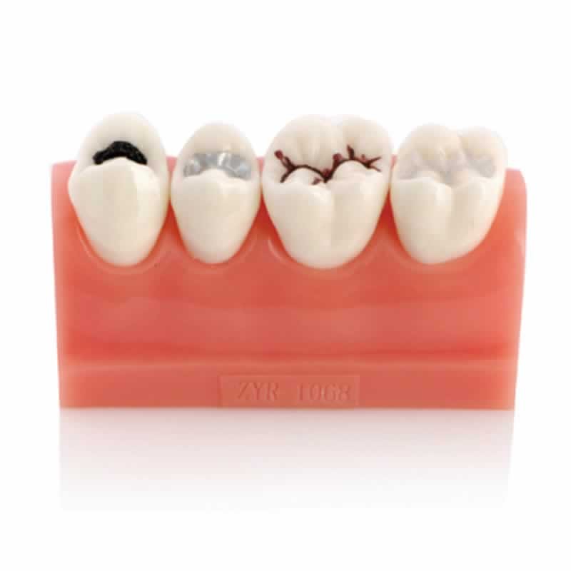 iDENTical Caries Model M4013