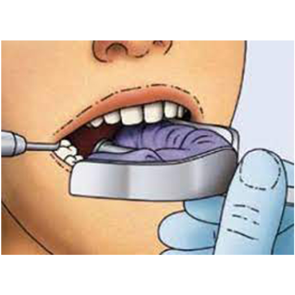 Gdc Impression Trays Dentulous Non Perforated