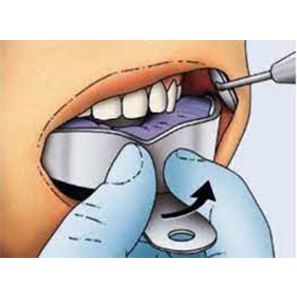 Gdc Impression Trays Dentulous Non Perforated