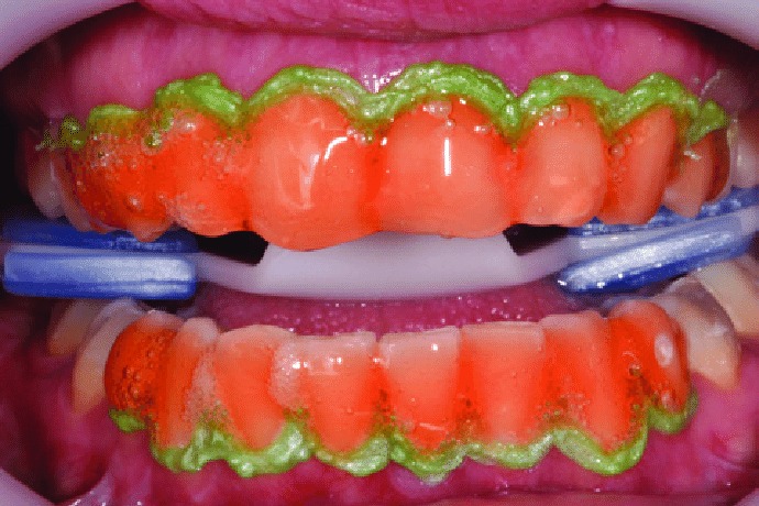 Mani Bleach'n Shine Office Bleach - 5gm (1 Syringe Pack)