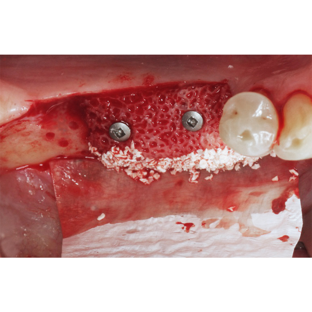 Julldent Membrane Stabilizing Kit and Refills