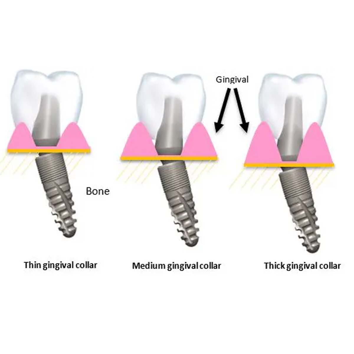 Xcem Dental Implant Angled Abutment Type B 5mm - Hex 