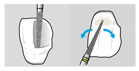 Shofu Direct Cosmetic Restoration Kit