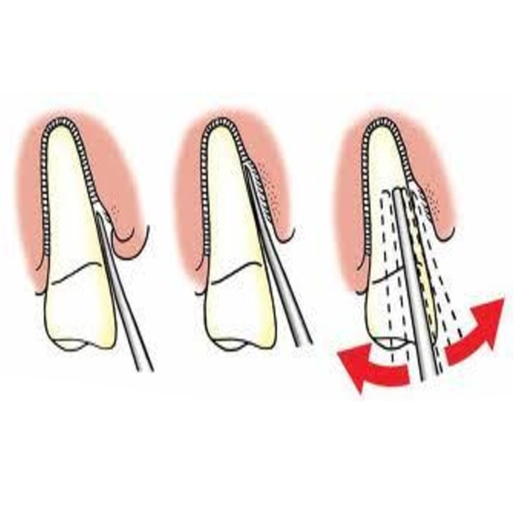 Oracraft Luxacut 3mm Straight - L3S