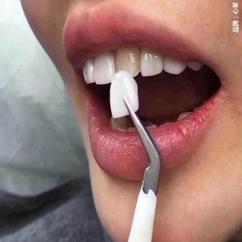 Endoking Preformed Temporary Crowns