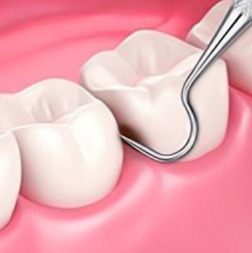 Waldent Explorer 23/17 ( 13/105 )