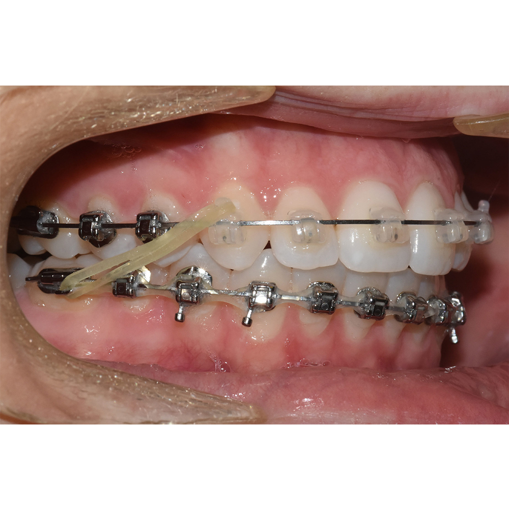 Prime Ortho Intraoral Elastics