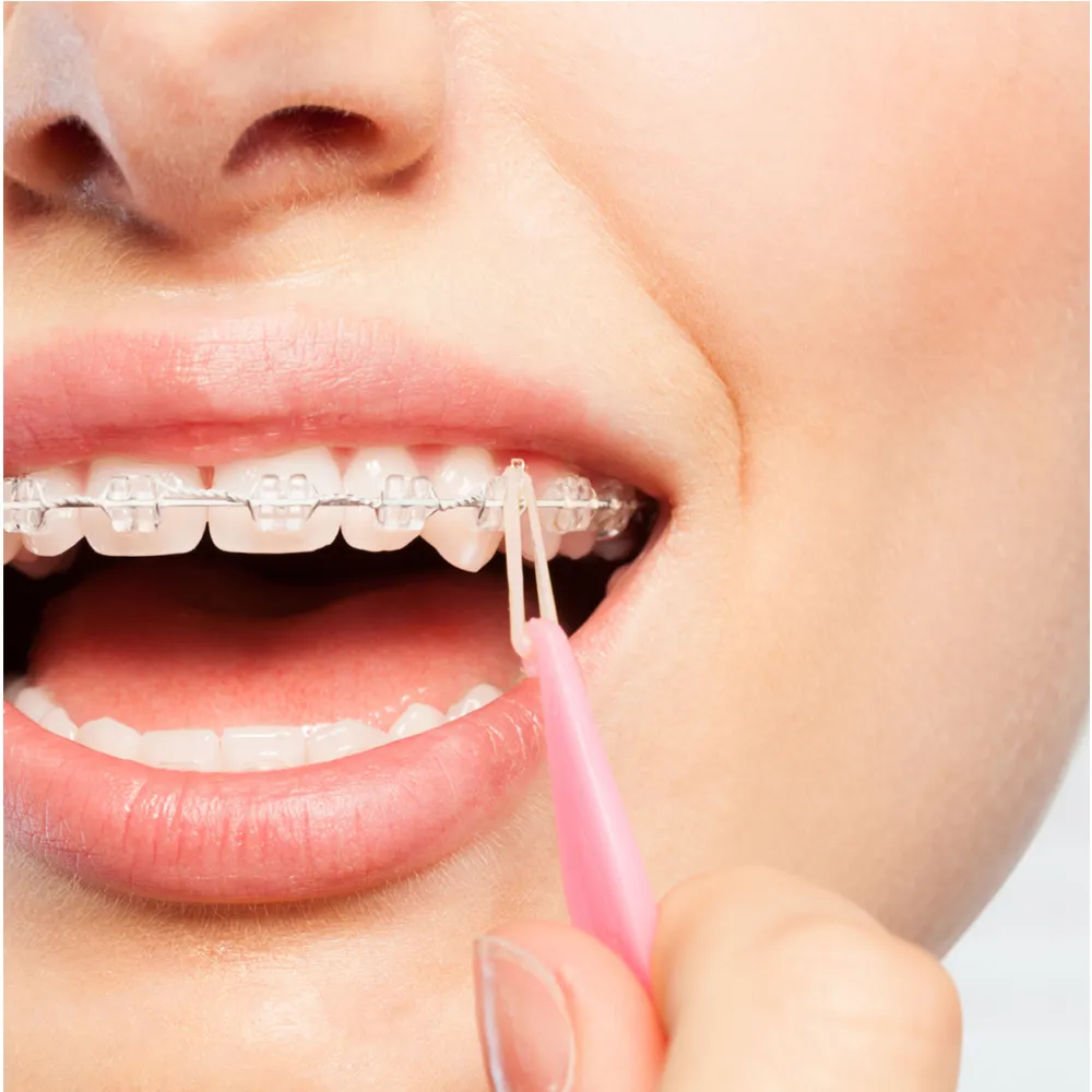 Dental Elastic Rubber Bands Placers for Braces Disposable Plastic Orth –  John Dental Supplies Inc