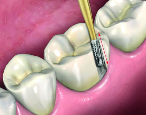 Prima Dental Predator Turbo Crown Removal Kit