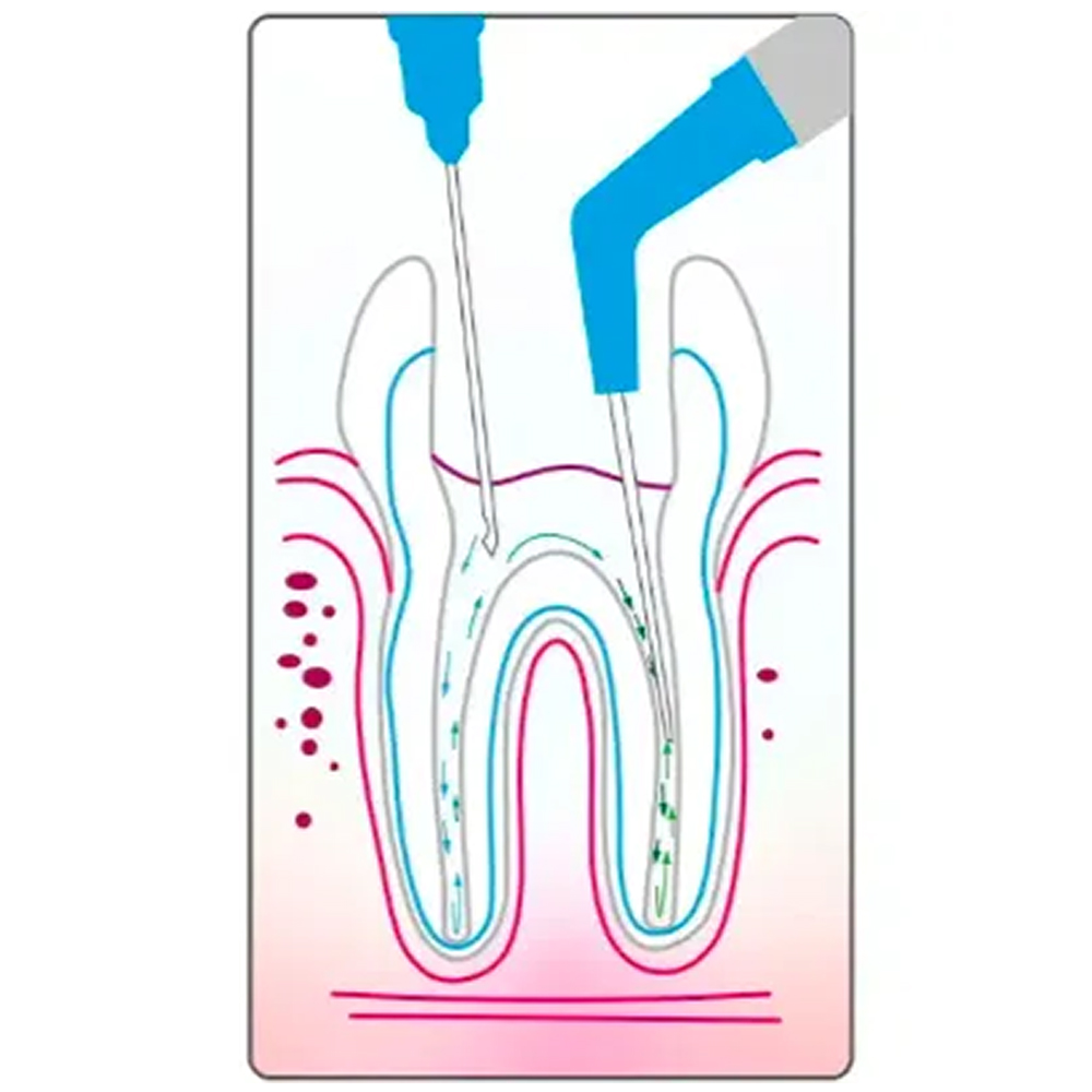 Younique Smart Endo - Surgic Pro Suction Set 