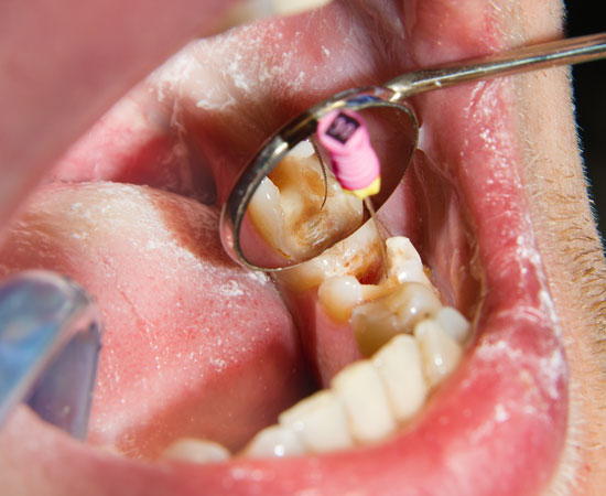 Waldent K-Flex Files 25mm