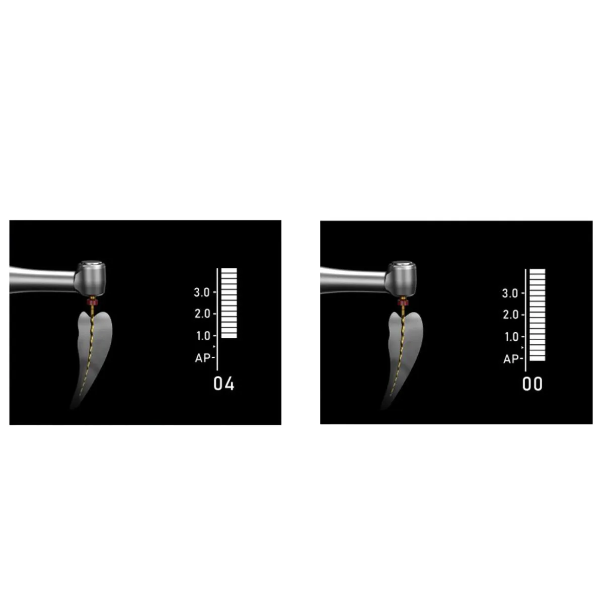 Woodpecker Endopace Pro Brushless Endomotor with In-built Apex Locator