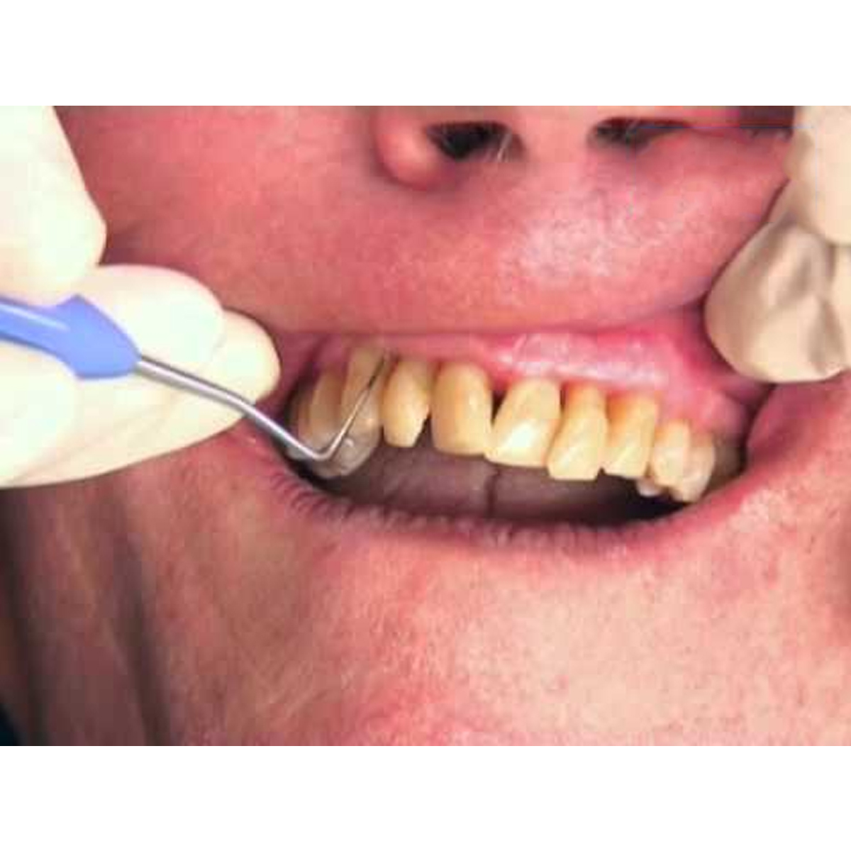 Hahnenkratt ERGOform Explorers