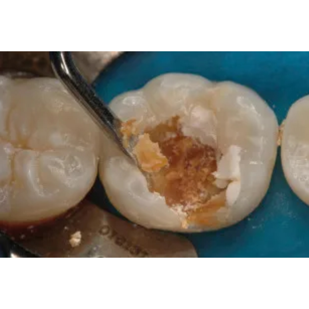 GDC Spoon Excavator Oval Shape #6 EXC18WH #6