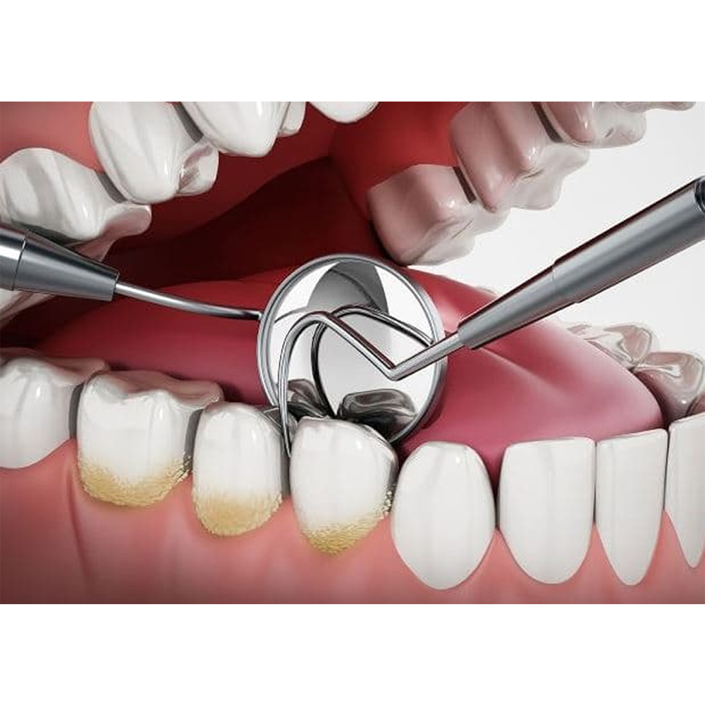 GDC Single End Probe -1 (Exs54)