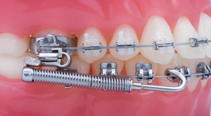 3m Unitek Forsus Fatigue Resistant Device Ez2 Module