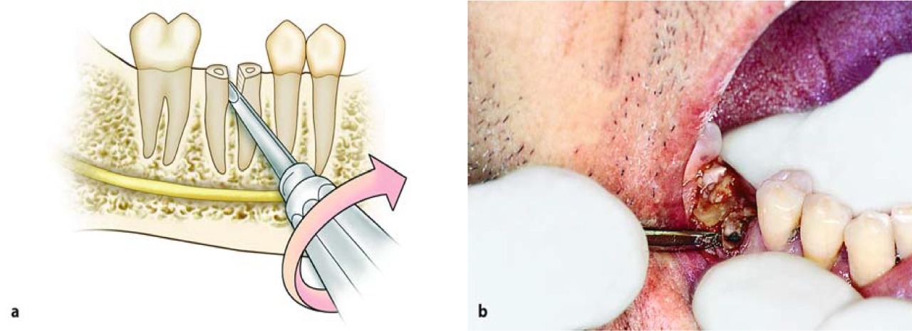 Waldent Root Elevators Premium Set of 11 (K2/2)