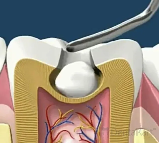 Waldent Plastic Filling Instrument + Ball Burnisher 15/731