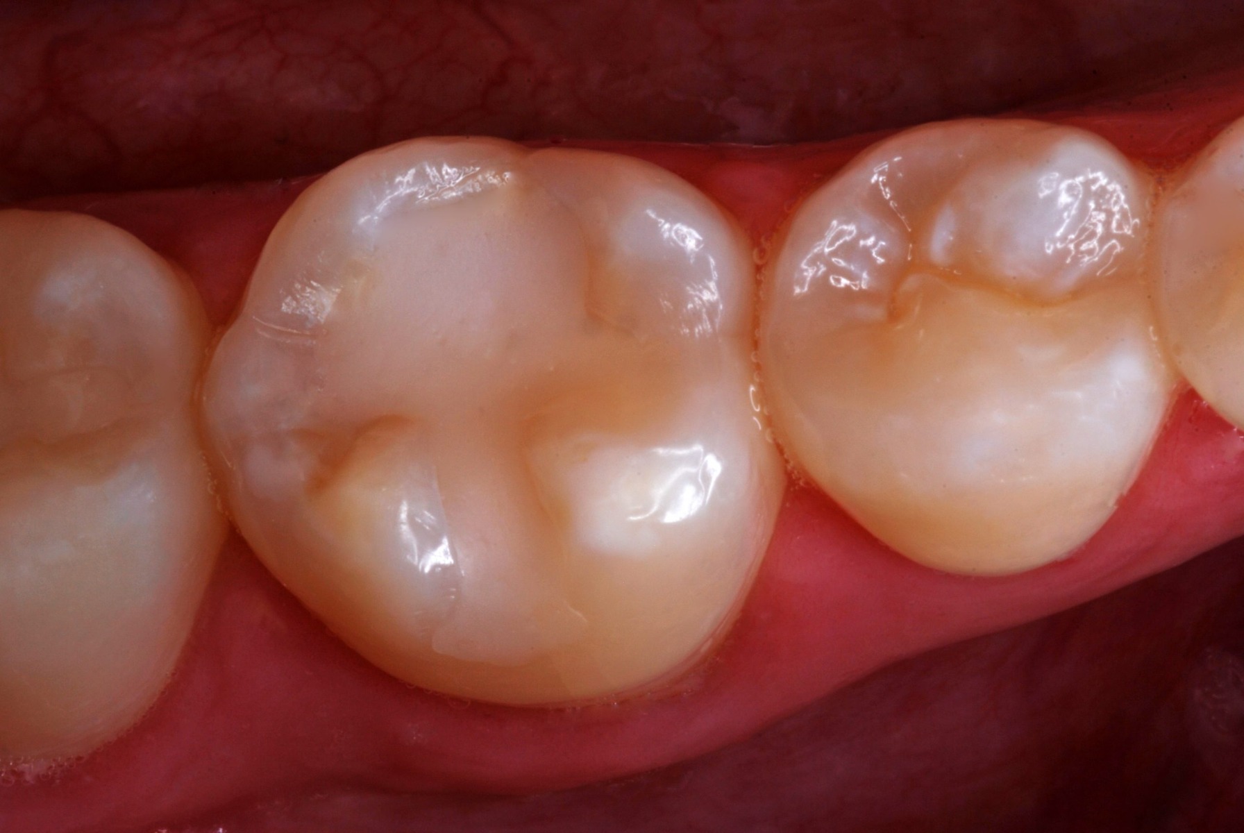 Ammdent Gi Fill Premium GIC