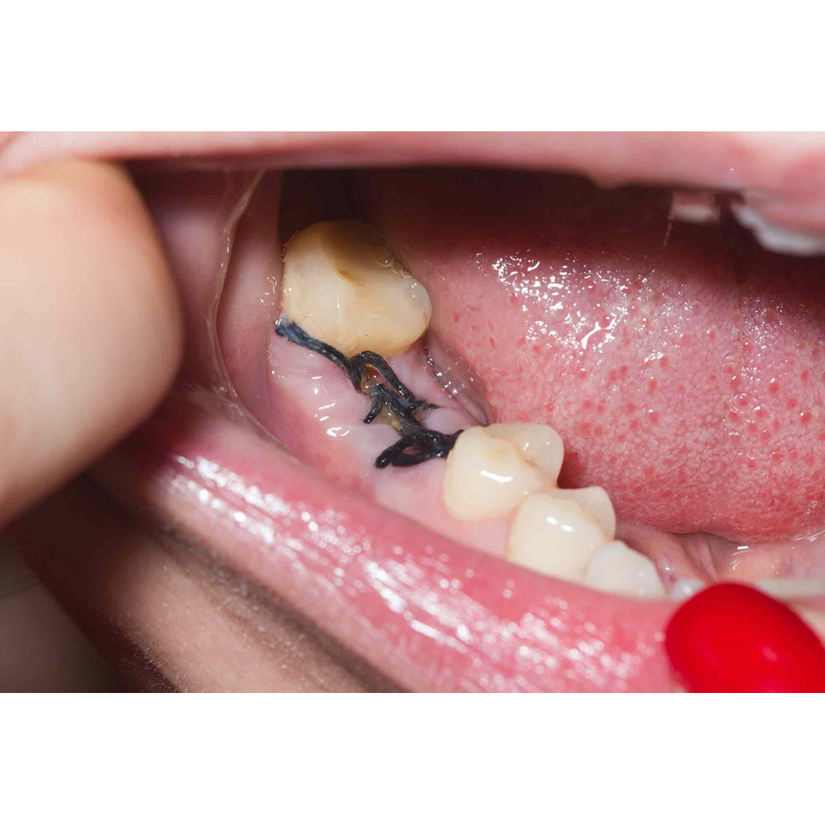 Meril Filaxyn #3-0 Polydioxanone Suture