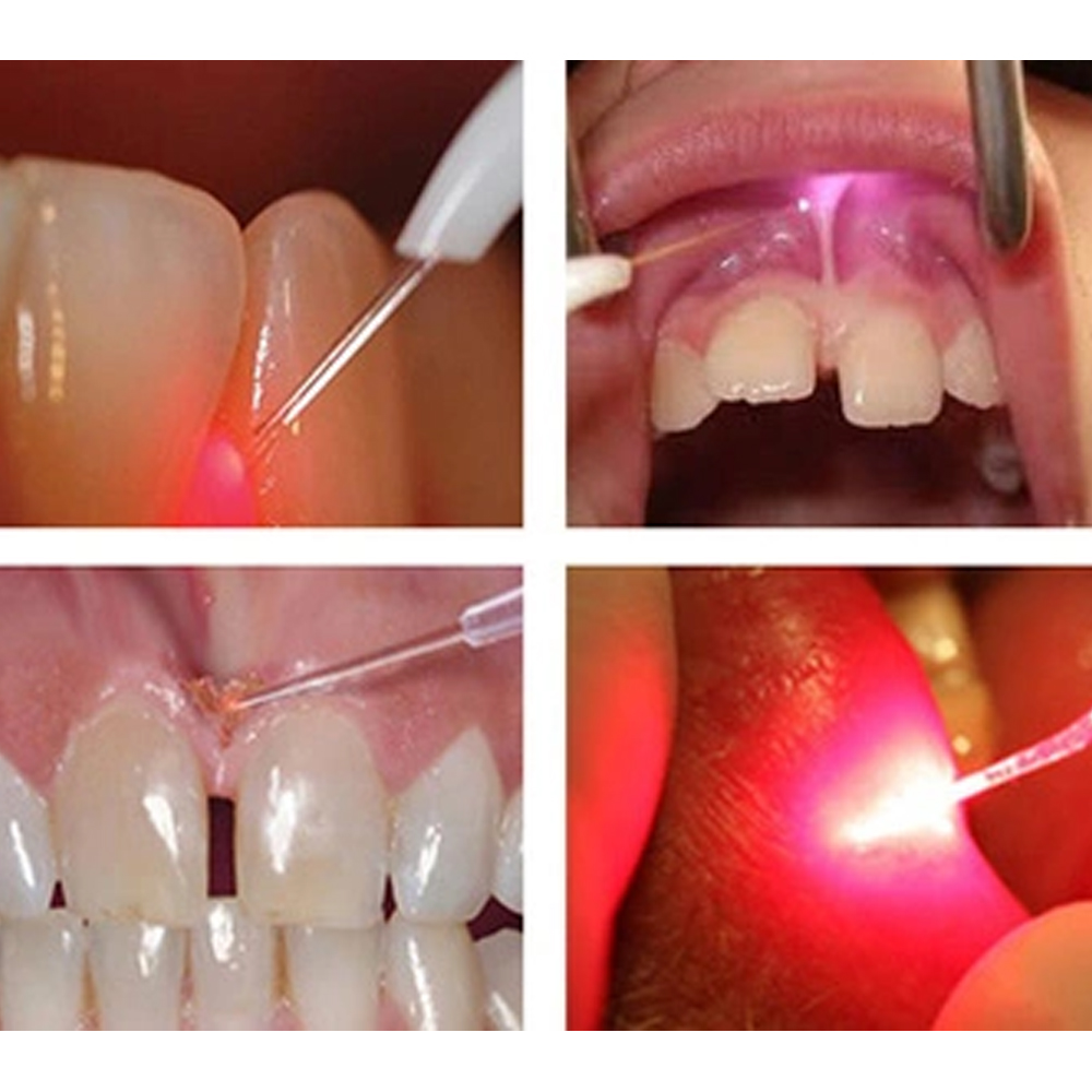 Woodpecker LX16 Diode Laser Handpiece With Cable 