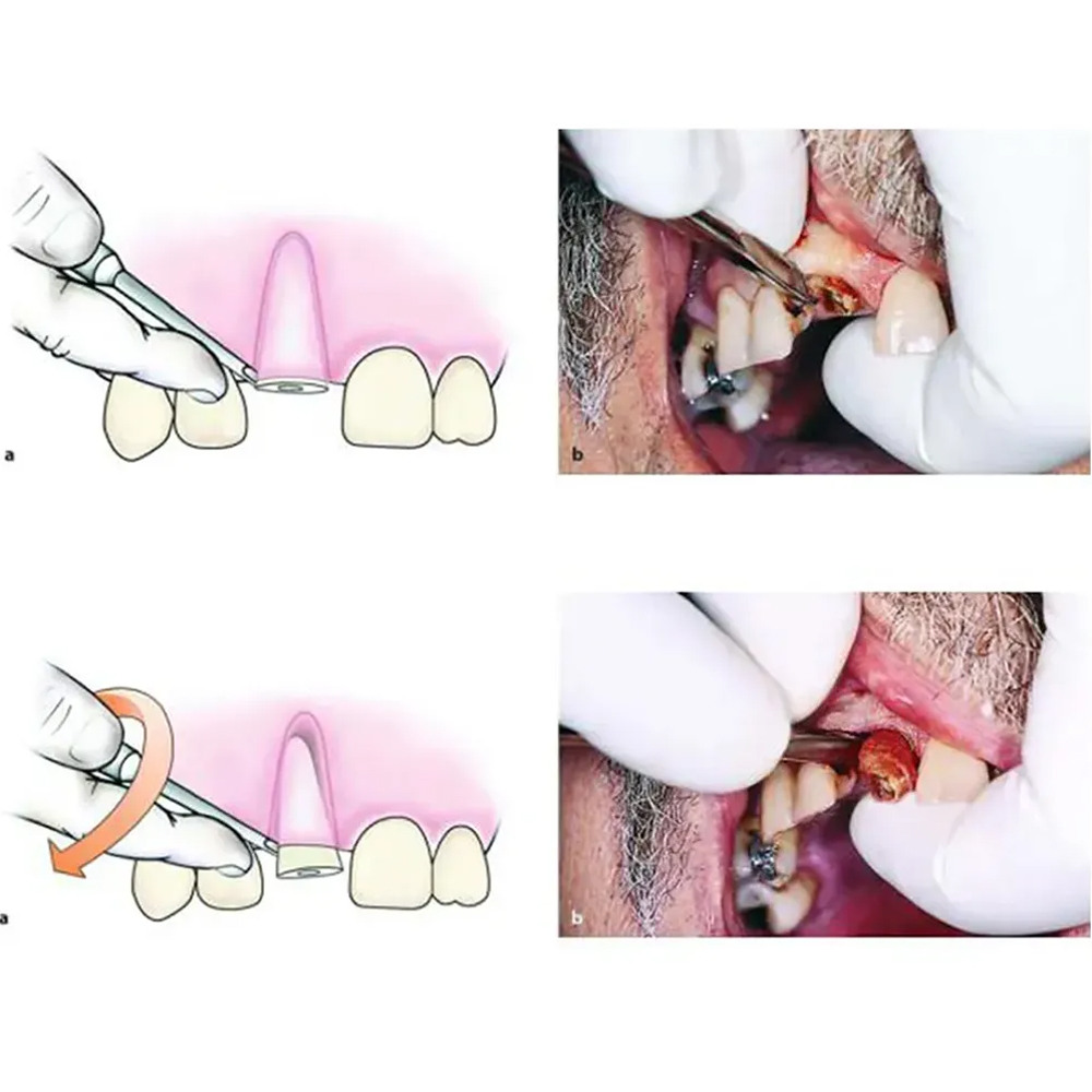 Medesy Heidbrink Root Elevator