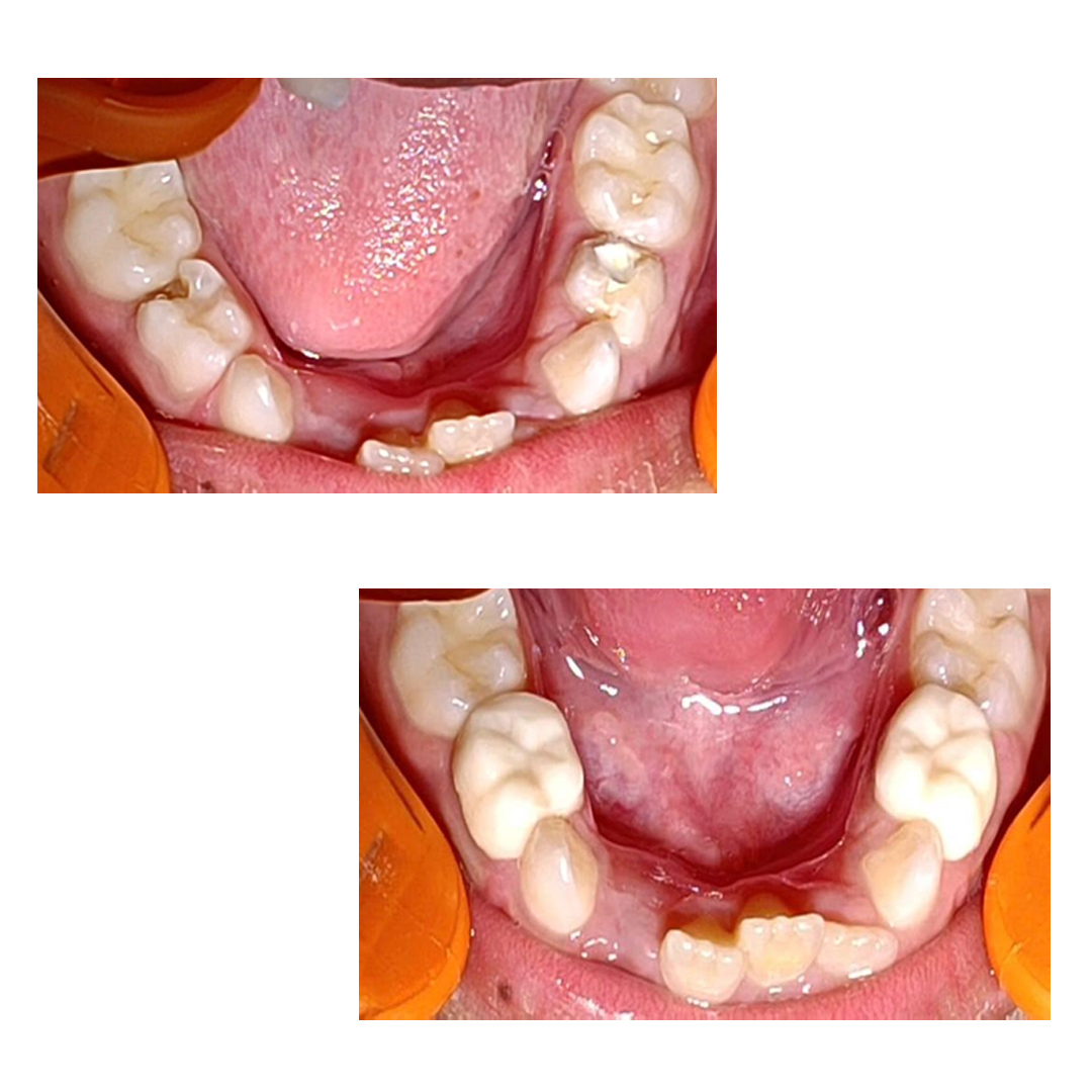Pedo Crown Primary Molar Kits