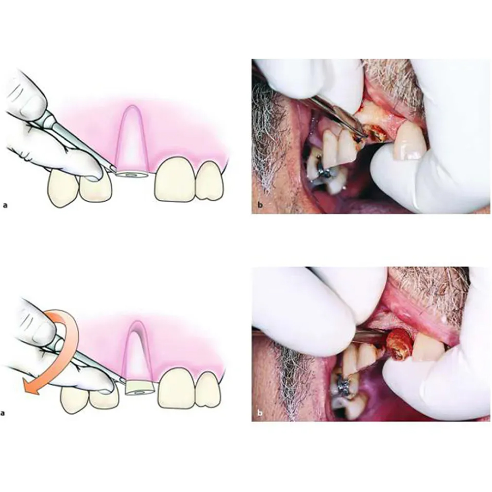 Oracraft Coupland Root Elevators