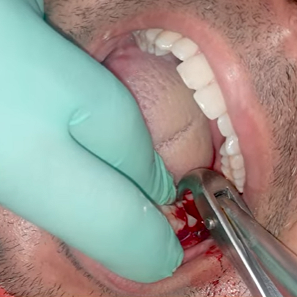 GDC Extraction Forceps Ergonomic