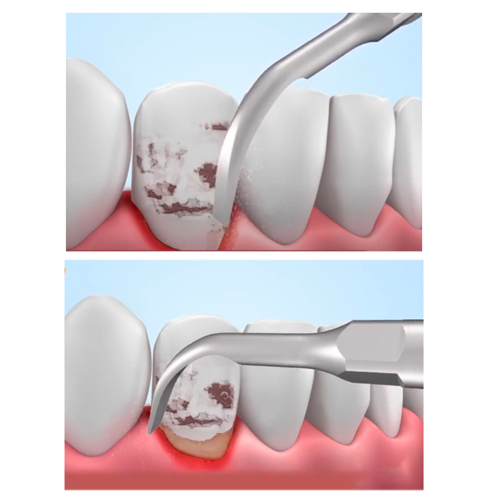 Woodpecker Scaler Tip GD2 for DTE & Satelec Scalers