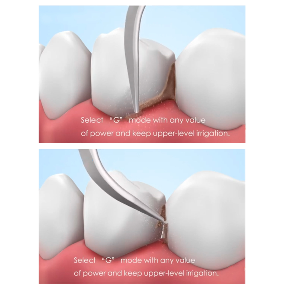 Woodpecker Scaler Tip GD3 for DTE & Satelec Scalers