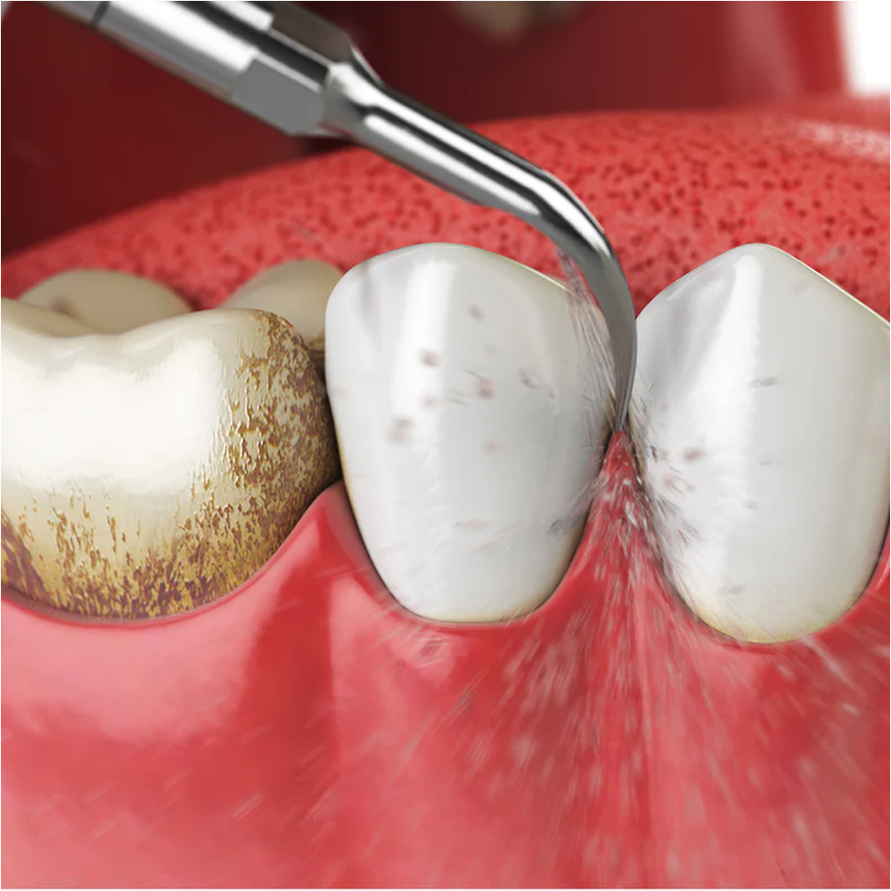 Woodpecker Scaler Tip G4 for UDS & EMS Scalers