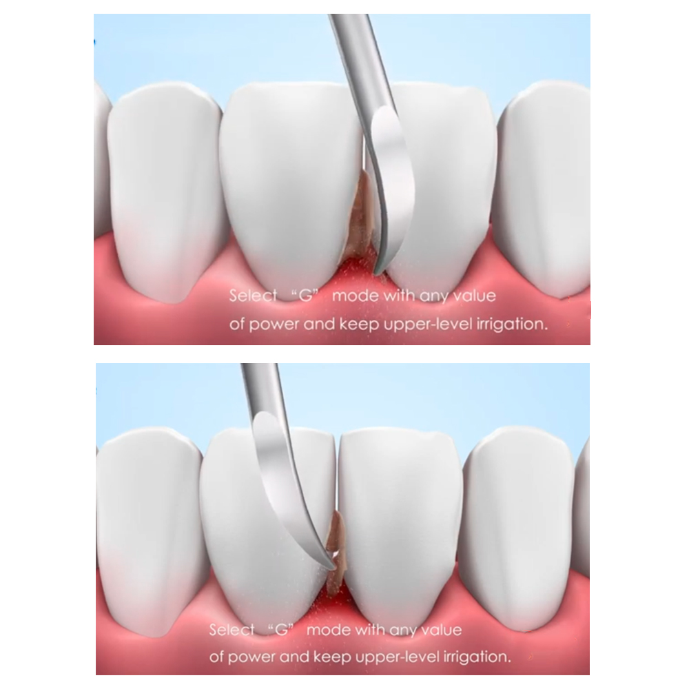 Woodpecker Scaler Tip G4 for UDS & EMS Scalers