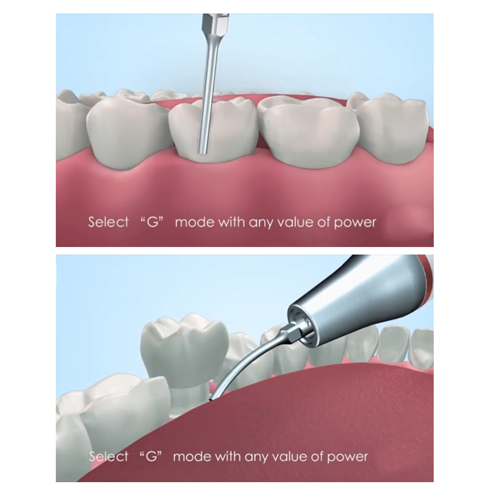 Woodpecker Scaler Tip GD7 for DTE & Satelec Scalers