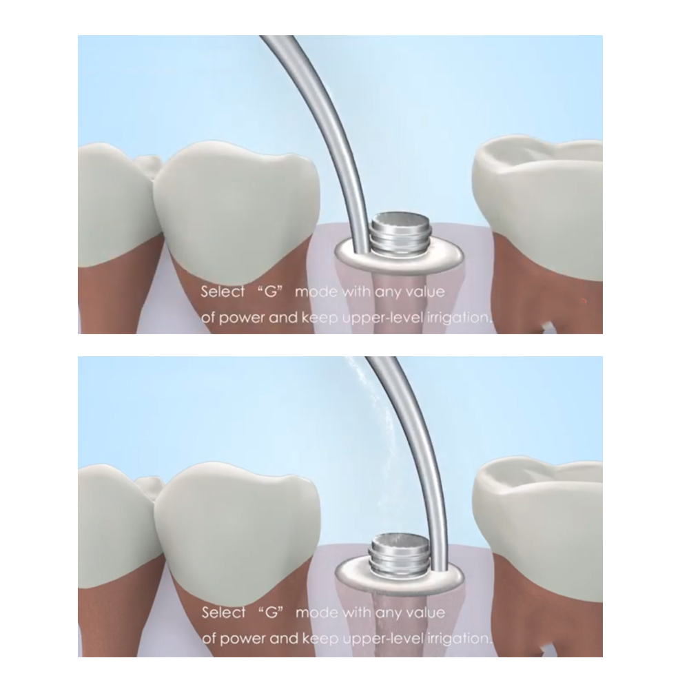 Woodpecker Scaler Tip GD8 for DTE & Satelec Scalers