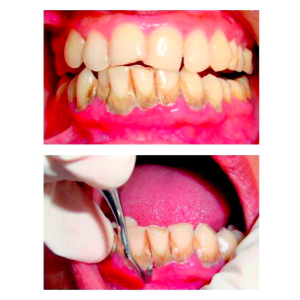 GDC Gracey Curettes #3 (Sg11/12)