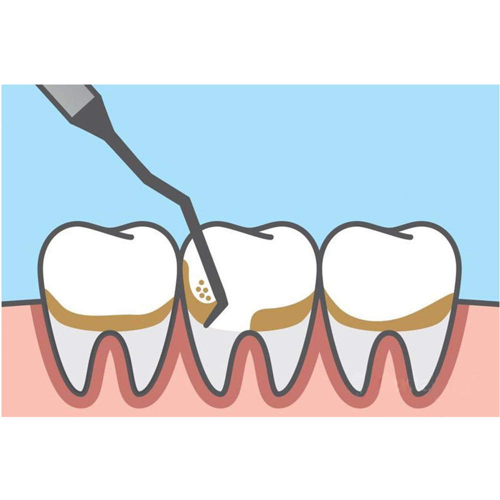 GDC Gracey Curettes #6 (Sg1/2)