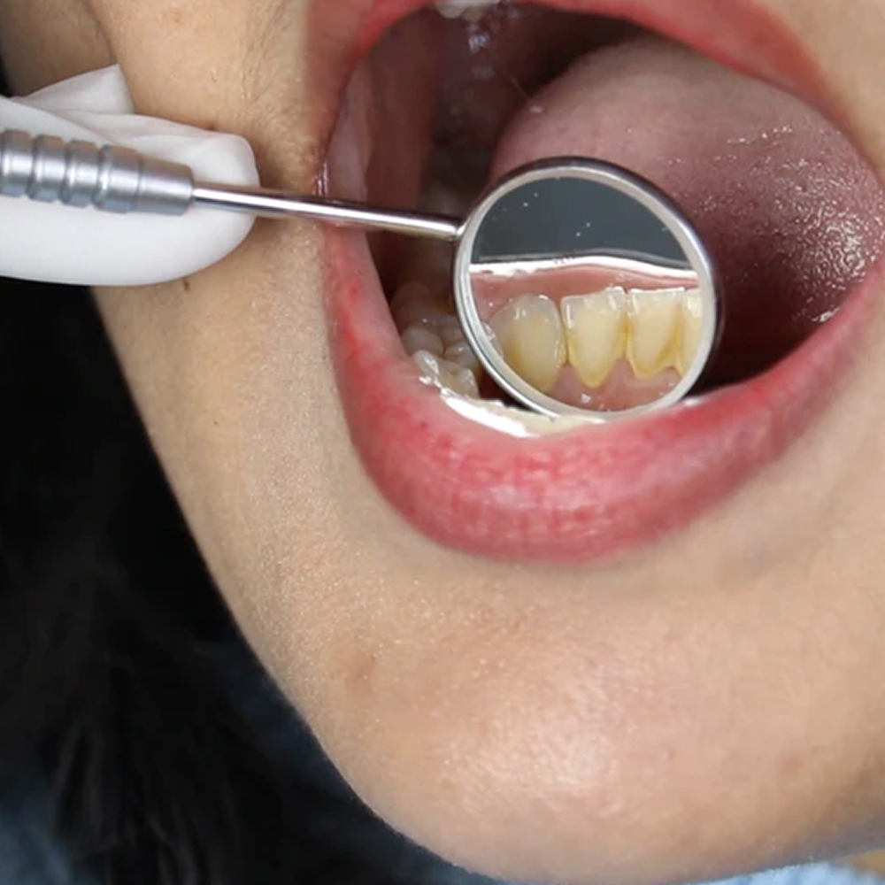 Waldent PMT Set Instrument Kit (Double Ended) (K13/2) 