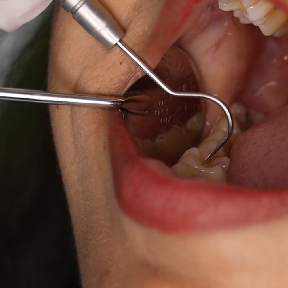 GDC Pmt Set Of 3 Instruments Kit Double Ended #3 (PMTS4)