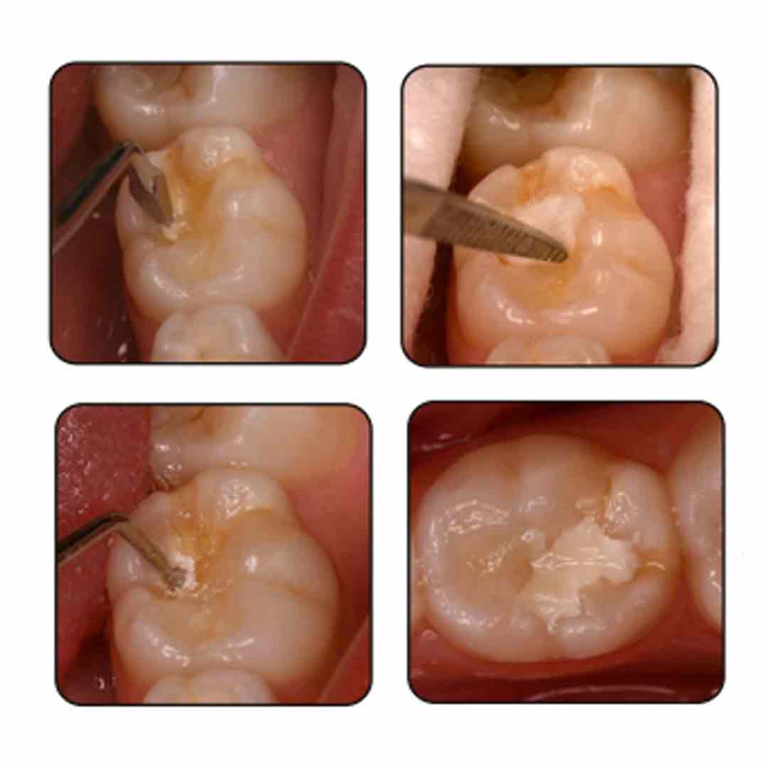GDC ART Atraumatic Restorative Treatment Instruments