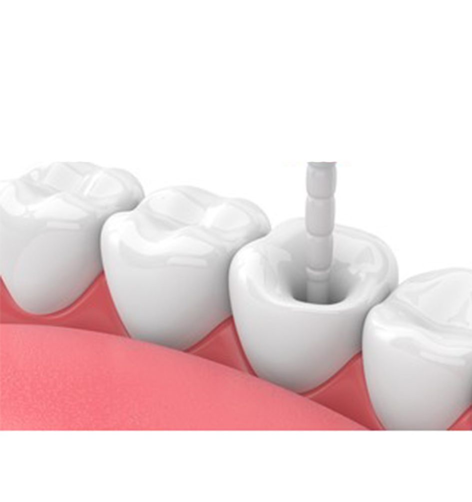 Endoking Fiber Post Refills
